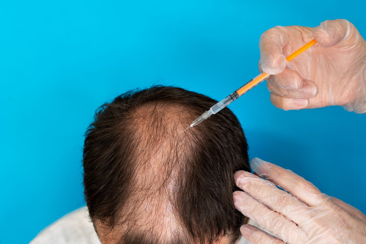 balding man receiving scalp PRP